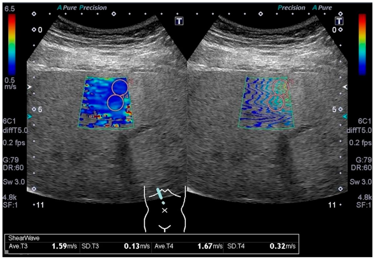 JCM_MDPI's tweet photo. #mdpijcm
New #Article “Correlation between Liver Stiffness by Two-Dimensional Shear Wave Elastography and Waist Circumference in Japanese Local Citizens with Abdominal Obesity” by Tomoki Miyoshi et al.
https://t.co/FLcvQvIl3X
#liverstiffness #shearwaveelastography
#localcitizens https://t.co/ALFRhKxsXP