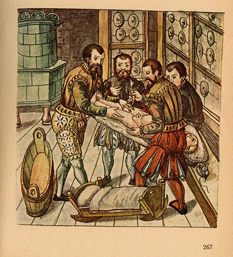 The castration ‘procedure’ was incredibly dangerous. The most common surgical technique was either to sever the spermatic cords or crush the testis with the fingers. The child would be heavily drugged throughout. (Image showing a castration, from Stromayr's 1559 Practica Copiosa)