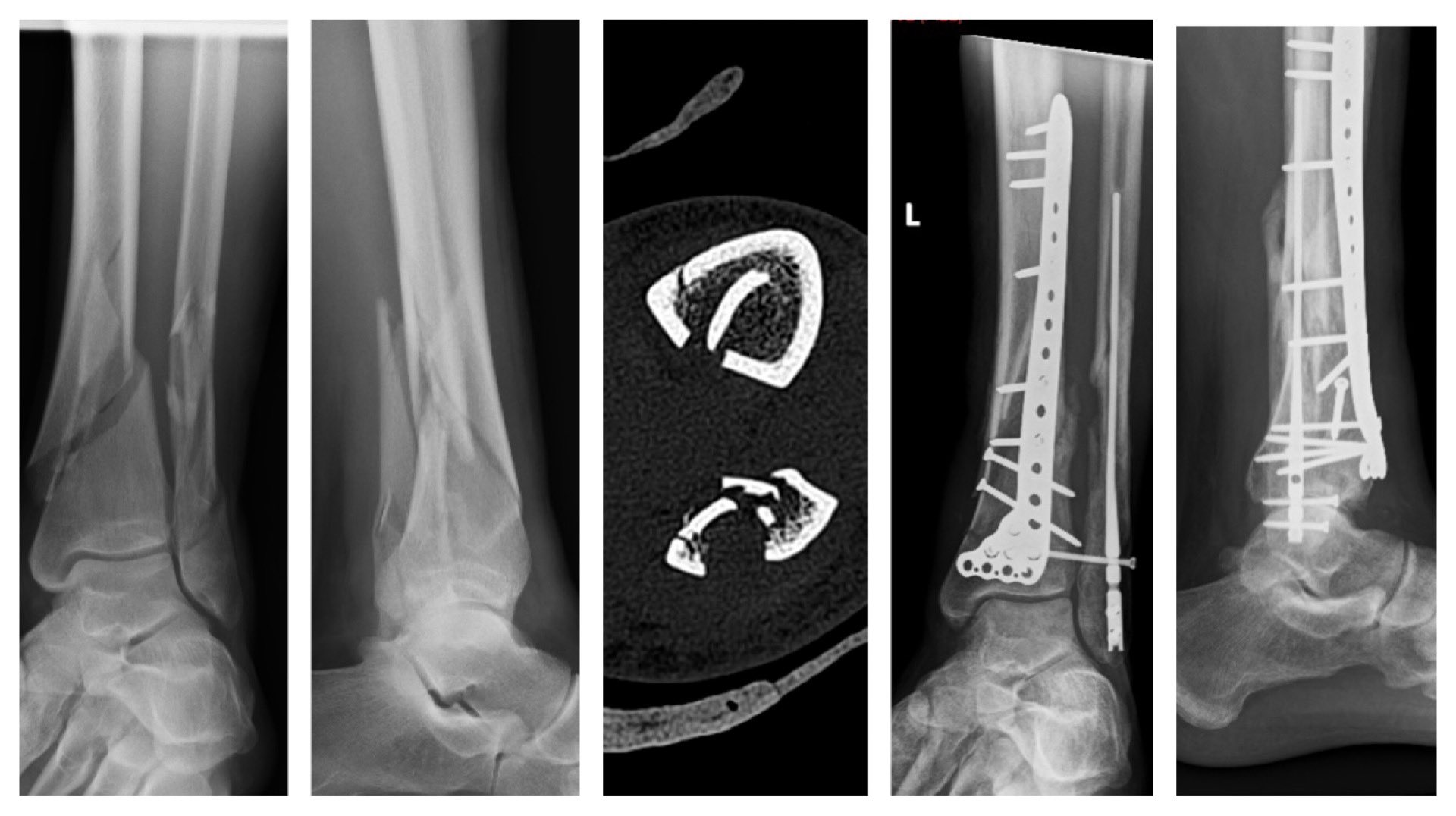 Comparison of suprapatellar versus infrapatellar approaches of  intramedullary nailing for distal tibia fractures | Journal of Orthopaedic  Surgery and Research | Full Text