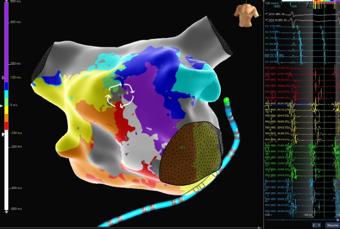 Patient presented in atypical atrial flutter with two prior LA ablations a decade prior.

#HDGrid Mapping Catheter was used to create reentrant LAT maps, quickly identifying the scar region and flutter activation patterns.

See the case and safety info: bit.ly/3tvm9rW