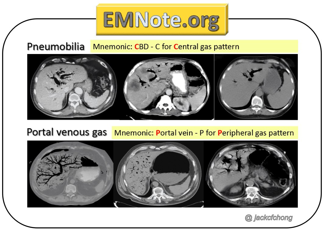 drkeithsiau's tweet photo. Pneumobilia 🆚 portal venous gas #MedEd #LiverTwitter 💡 

(Courtesy of @thame &amp; @jackcfchong) https://t.co/coqcv65wyi
