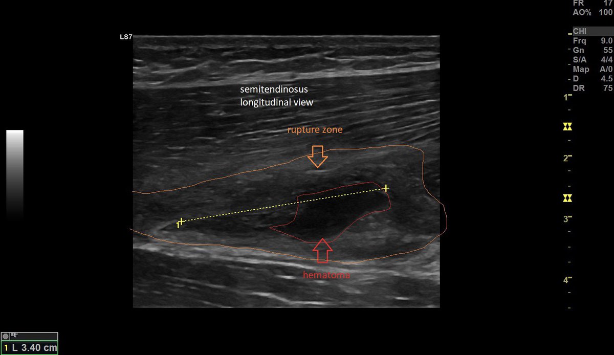 SportklinikBern's tweet photo. #muscleinjury #muscletear #semitendinosus grade 3B —> end of the match during sprinting #mskus #pocus #pocushub #s7r3 # #sportsinjury #footballinjury #logiqview #3dultrasound https://t.co/zXWcXp25Ms