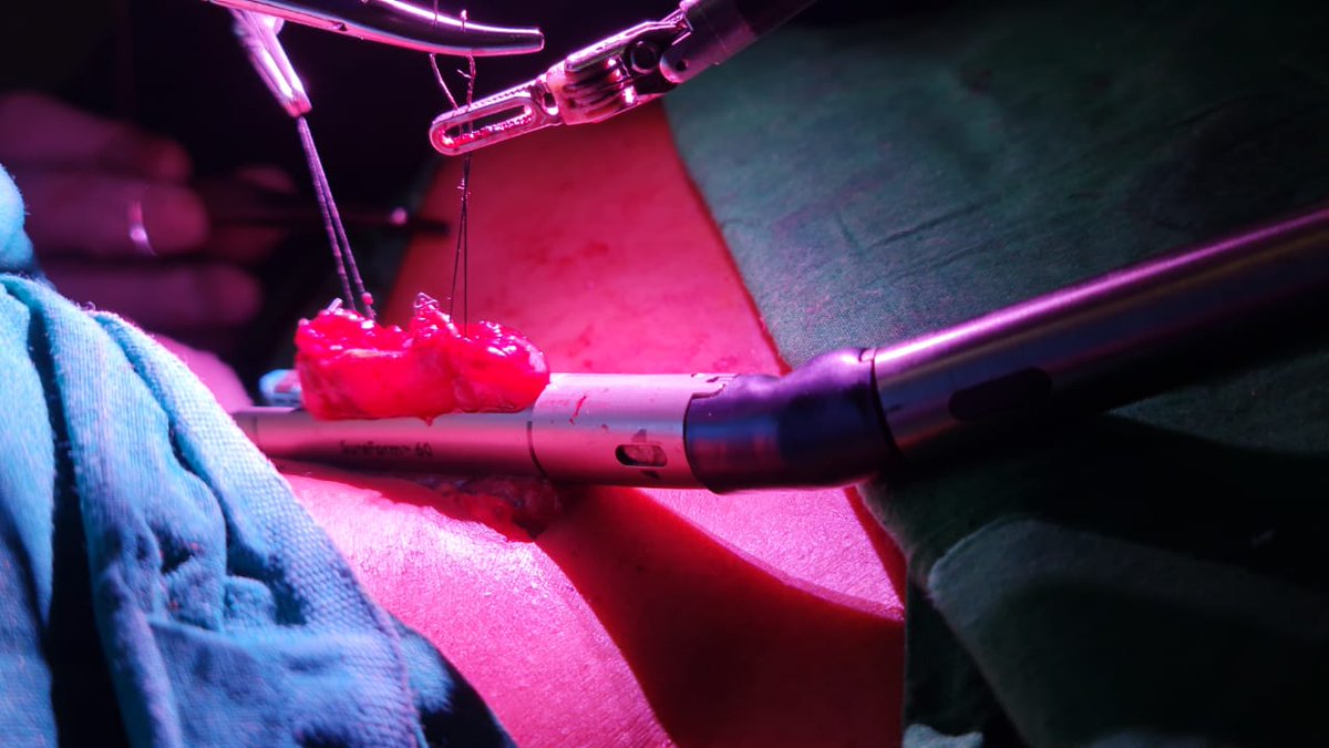 DevendraGParik1's tweet photo. CERVICAL ESOPHAGOGASTRIC ANASTOMOSIS with DV Xi in Robotic Esophagectomy https://t.co/z3xMvSEhtU via @YouTube https://t.co/VebVVKqp67