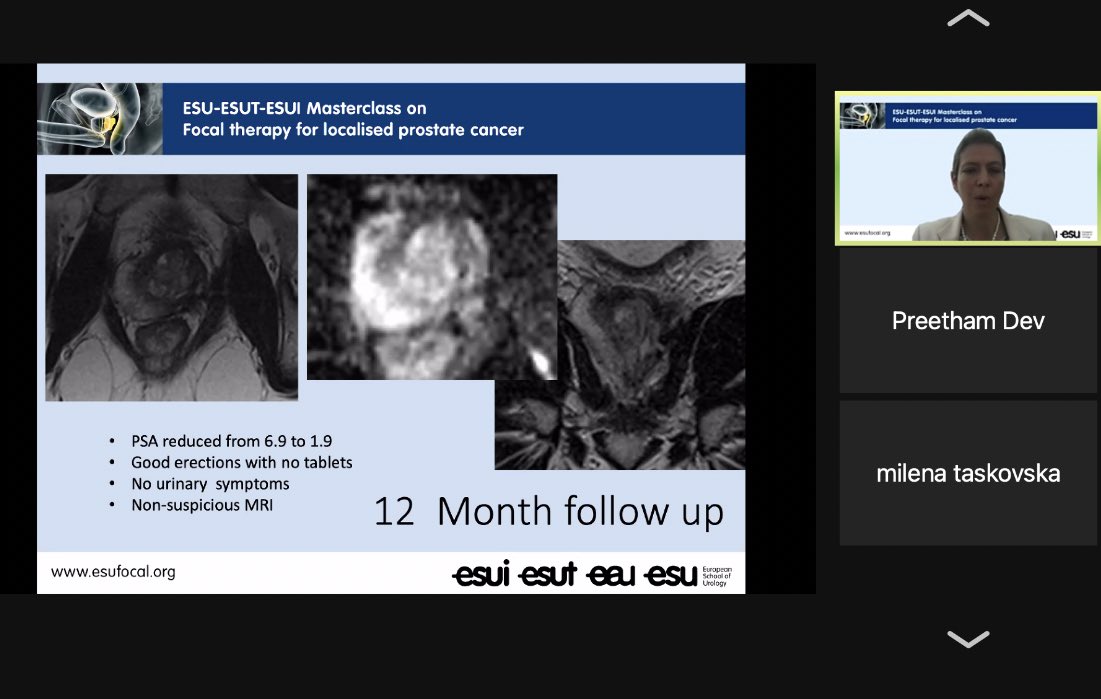 JGomezRivas's tweet photo. @mrsprostate shows the rationale for Focal Therapy in #prostatecancer treatment and the value of identification and target using MRI. See the pre/post treatment changes after HIFU ablation. Proud of sharing the “virtual” floor with her today! @barret_e @Dmitry_Enikeev https://t.co/0CEmOVqSHp