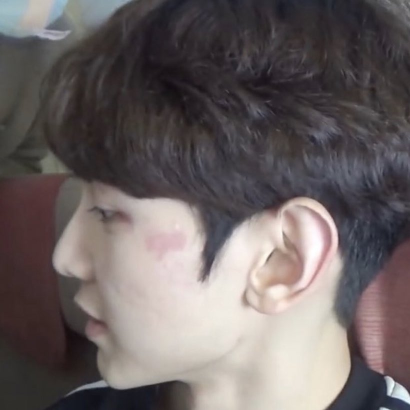 every possible photo i can find of yeosang’s birthmark: a thread