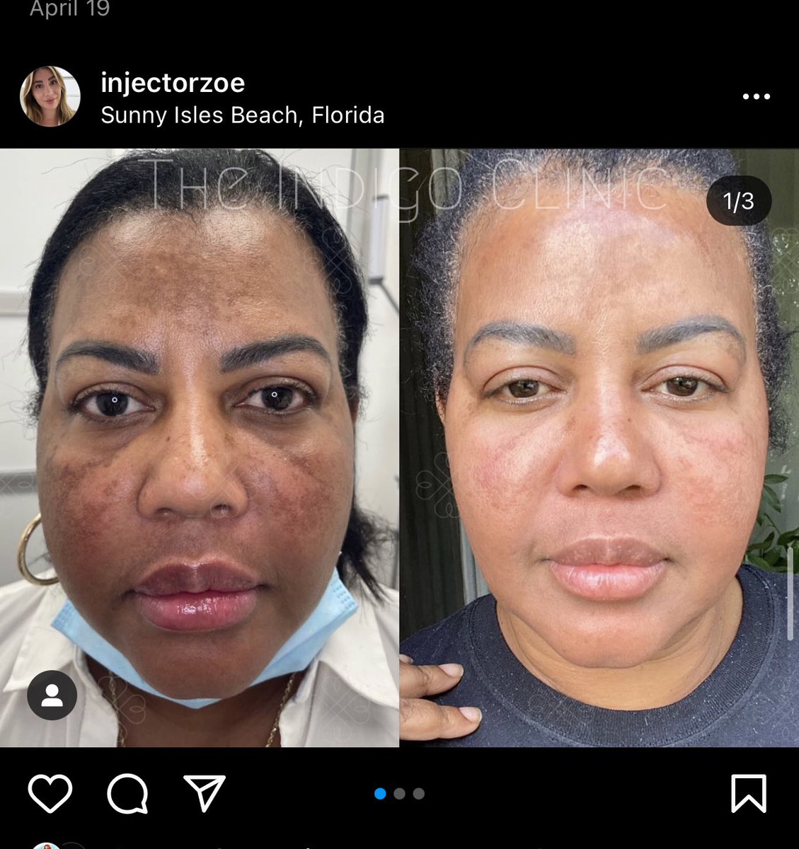 Enlighten Peel in Miami by Injector Zoe