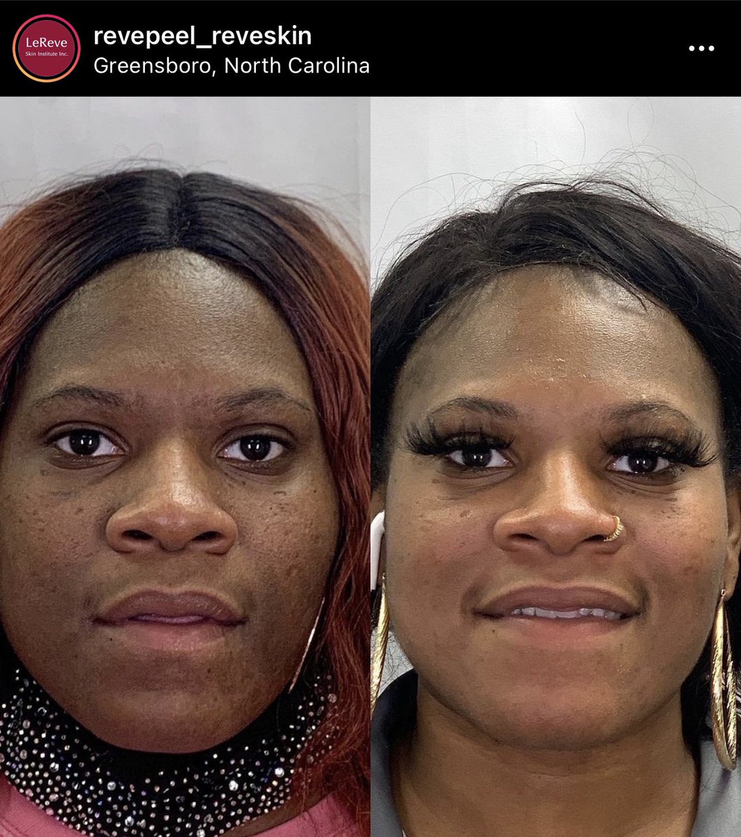 Enlighten Peel in Greensboro North Carolina by Dr. Chaudhary