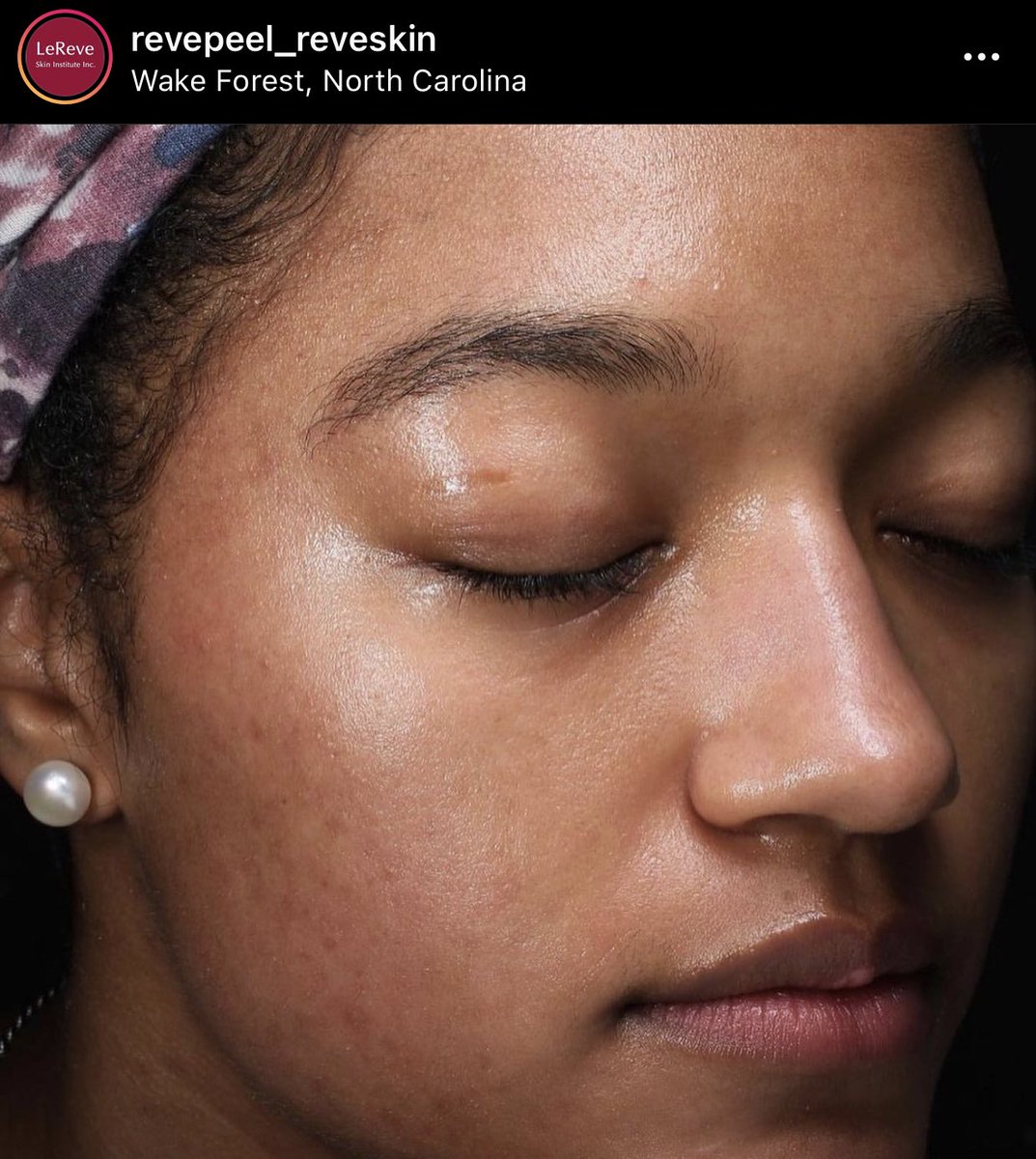 Enlighten Peel in Wake Forest North Carolina by LunaSol Med Spa