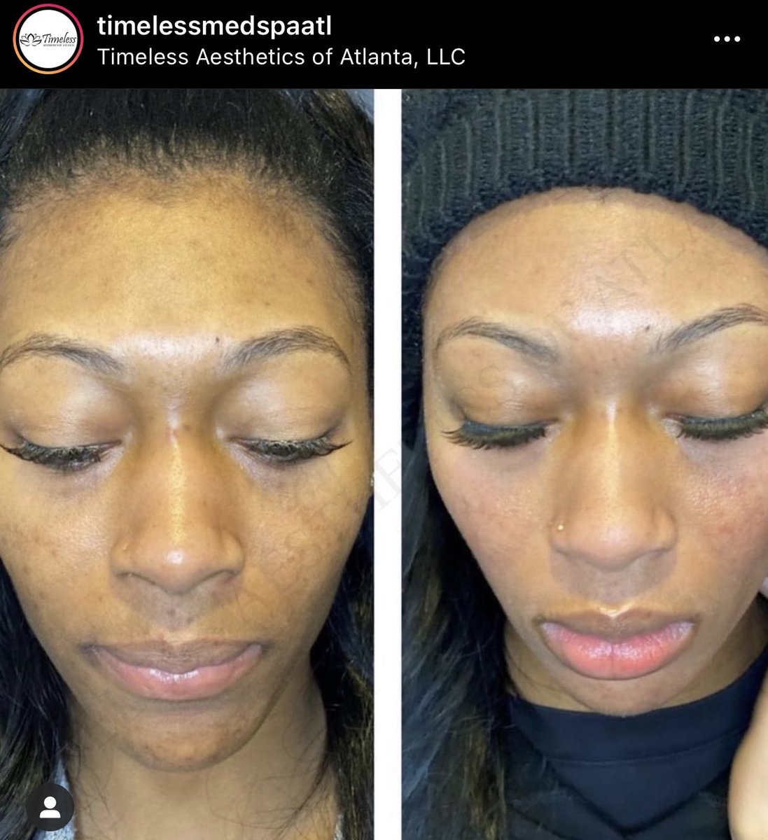 Enlighten peel in Atlanta at Timeless Med Spa