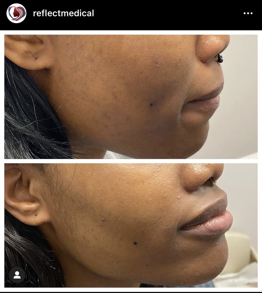 Enlighten Peel in Hawthorne New Jersey at Reflect Medical & Cosmetic