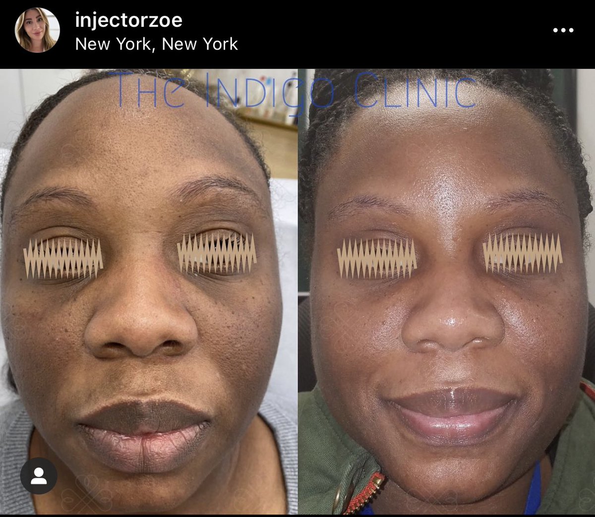 Enlighten Peel in NYC by Injector Zoe. She’s also allowed to provide it virtually. She charges 550/675 (may have changed) + shipping