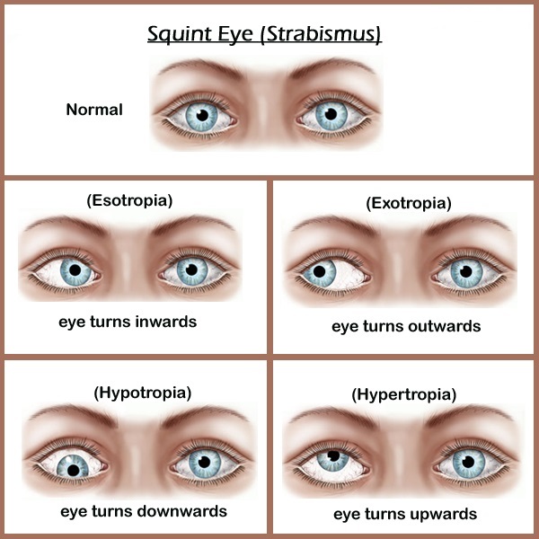 jclinicalmedres's tweet photo. Journal of Clinical and Medical Research has recently published a Case Report "Recovery of Stereopsis After Squint Surgery".
Read this interesting case report: https://t.co/7LqkyNMcOS
#Stereopsis #SquintSurgery #research #clinicaltrials #clinicalstudies #medical #socialmedia https://t.co/yg8t3AMJkH