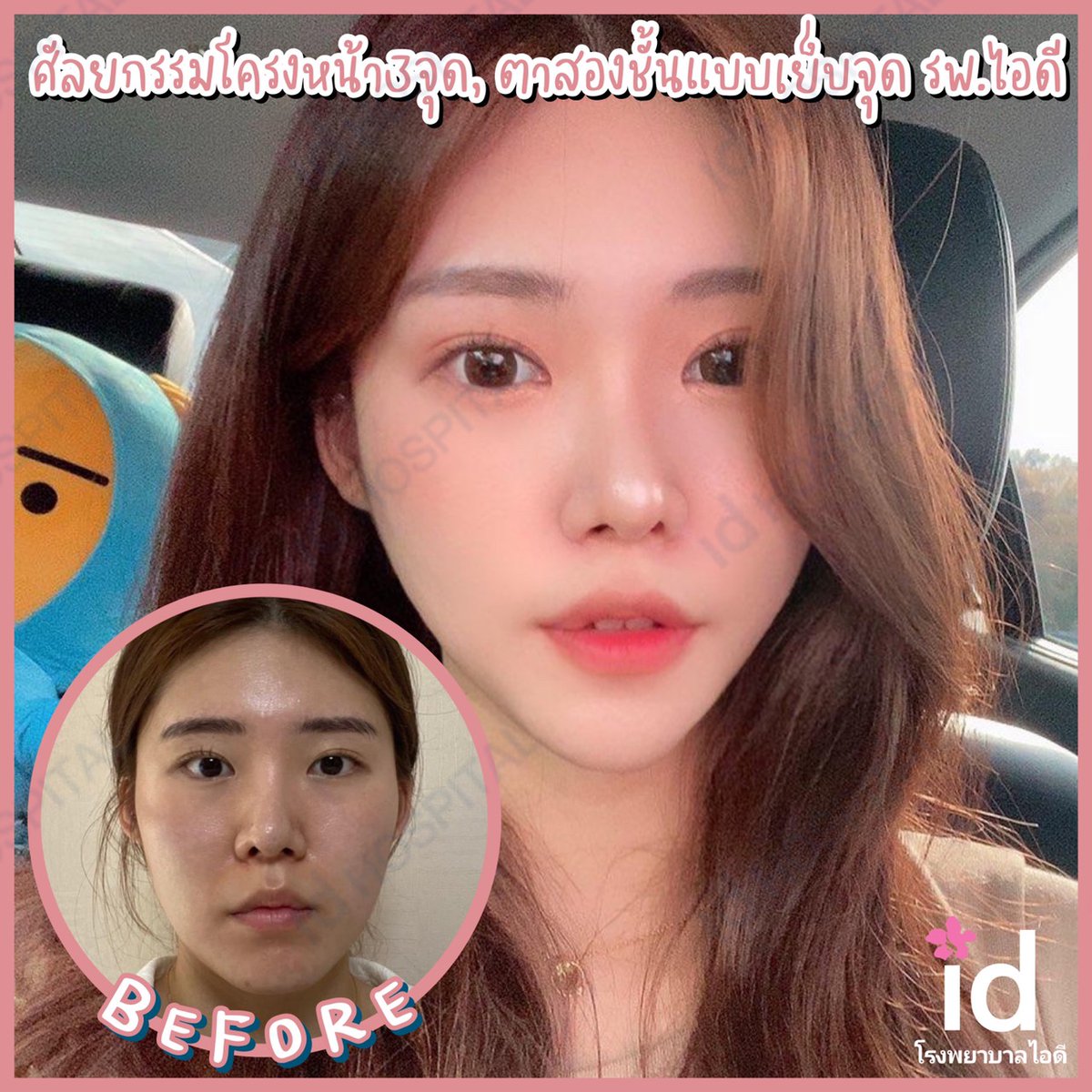 KKsurgery's tweet photo. @KKsurgery #kksurgery

https://t.co/WVaCrQUdAc

#oppaksurgery #ccsurgeryagency #beautinabytena #โรงพยาบาลไอดี #โรงพยาบาลศัลยกรรมไอดี #idhospital #คนไทยในเกาหลี #คนไทยในเกาหลีใต้ #ศัลยกรรมเกาหลี #โรงพยาบาลศัลยกรรมเกาหลี #ทีมปรึกษาศัลยกรรมมืออาชีพ #ศัลยกรรม https://t.co/bKLveVUihN https://t.co/gSB7ZRxOoY