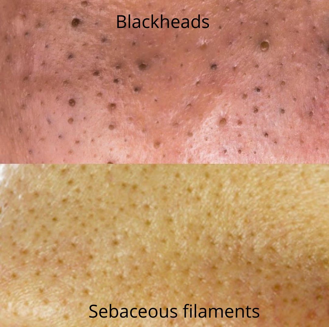 Atletico abbaiare Cinquanta sebaceous filaments treatment questionario