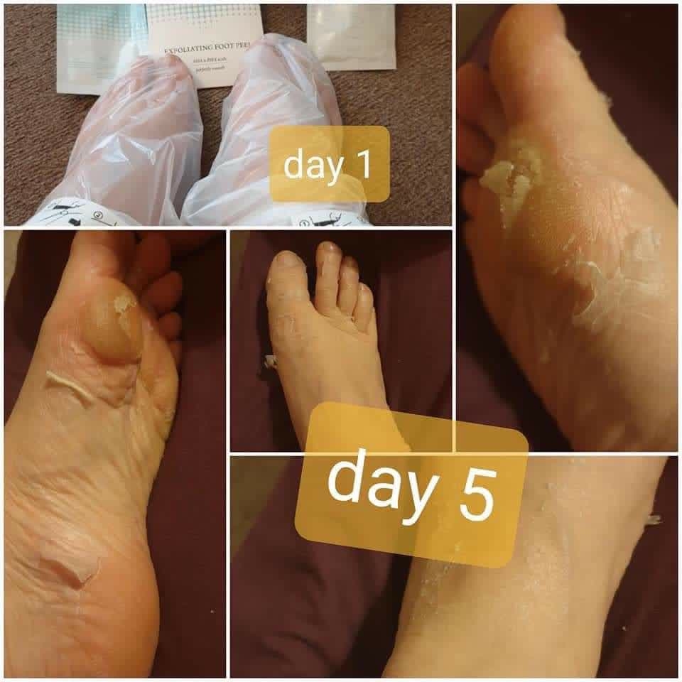 wow this is the results from our amazing foot cream if you suffer from really bad dry skin like this or any kind of dry skin on your feet then you need to try our skin care feet range just look at how amazing these results are absolutely shocking and only in 5 days as well 😳😍