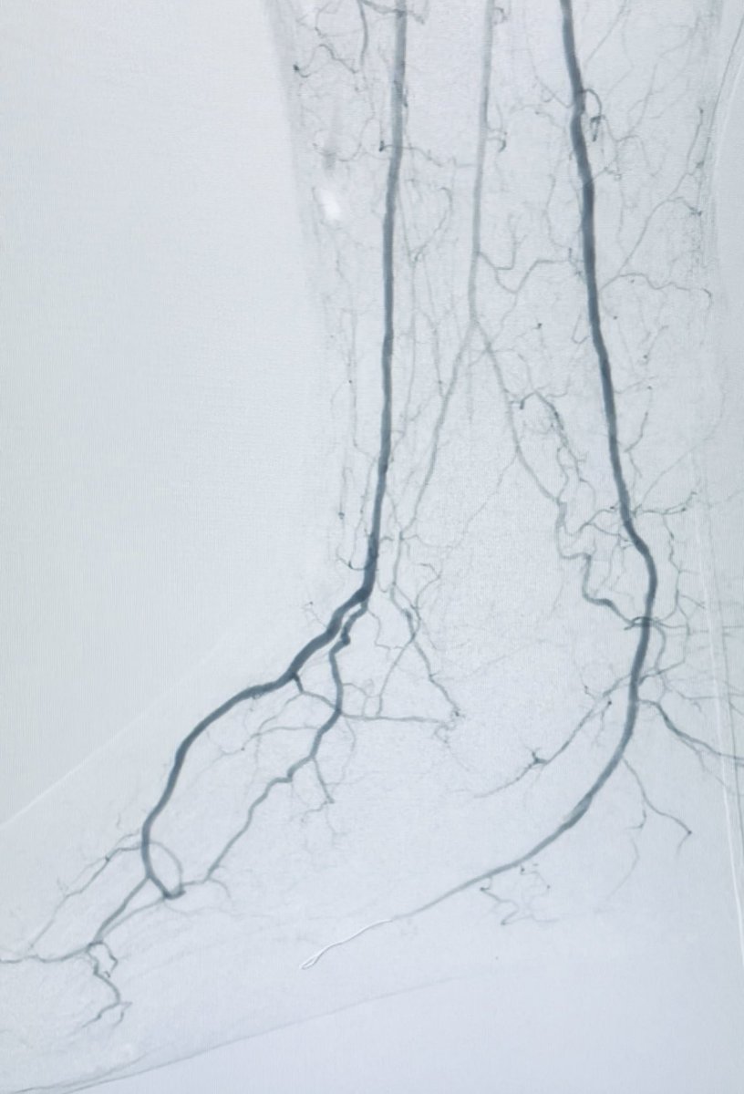 Carlos Guevara MD, FSIR (@carlosguevarair) on Twitter photo distal calf and toe wounds, PT occluded, calcified lateral plantar, atherectomy of distal PT and plantar, and plasty of entire PT <a href="/Sushinsk/">Sasha Ushinsky</a> @Saukalaka <a href="/ZagumBhatti/">Zagum Bhatti MD</a> <a href="/VISLAMDSCAIP/">GVATAKEN</a> <a href="/WashUIR/">Mallinckrodt IR</a> <a href="/SDhandMD/">Sabeen Dhand</a> <a href="/roblookstein/">Robert A Lookstein MD, MHCDL</a> <a href="/SIRspecialists/">Society of Interventional Radiology</a> <a href="/MoonJustaniah/">Almamoon Justaniah,MD, FSIR المأمون إبراهيم جستنيه</a> <a href="/docTPlive/">Tino Peña</a> distal calf and toe wounds, PT occluded, calcified lateral plantar, atherectomy of distal PT and plantar, and plasty of entire PT <a href="/Sushinsk/">Sasha Ushinsky</a> @Saukalaka <a href="/ZagumBhatti/">Zagum Bhatti MD</a> <a href="/VISLAMDSCAIP/">GVATAKEN</a> <a href="/WashUIR/">Mallinckrodt IR</a> <a href="/SDhandMD/">Sabeen Dhand</a> <a href="/roblookstein/">Robert A Lookstein MD, MHCDL</a> <a href="/SIRspecialists/">Society of Interventional Radiology</a> <a href="/MoonJustaniah/">Almamoon Justaniah,MD, FSIR المأمون إبراهيم جستنيه</a> <a href="/docTPlive/">Tino Peña</a>