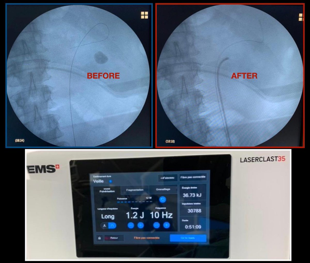 BN54: the new Holmium:YAG 35watts from EMS. Nothing new, but just to confirm that it works well as an excellent Ho:YAG low power system. In terms of Holmium technology and RIRS: low power (30-35W) is enough to perform perfectly.