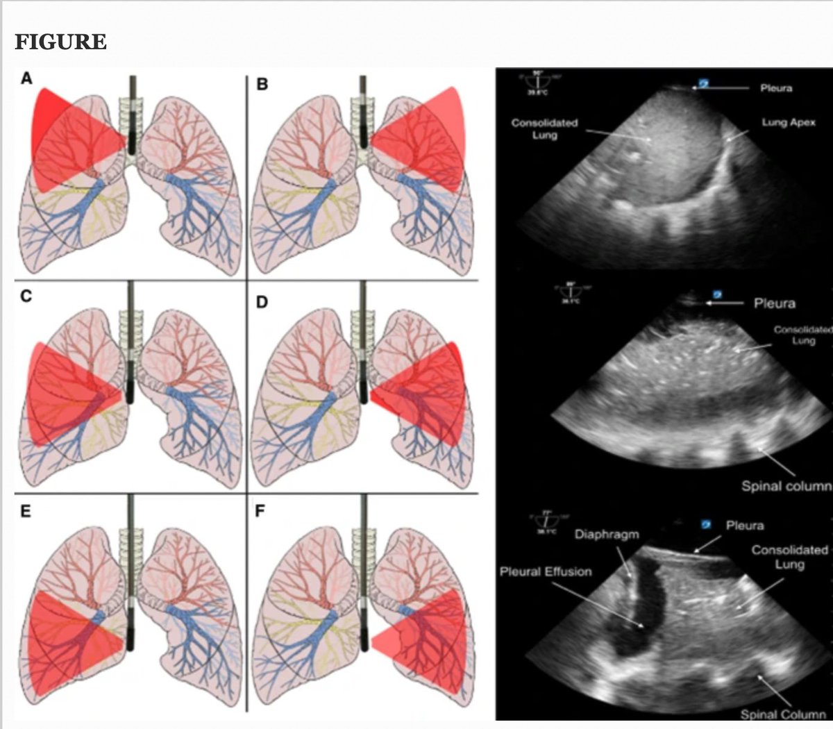 Lung ultrasound via TEE: 

may sound like a #POCUS party trick, however in our routine ICU use we find

-offers crucial answers not available on routine LUS
-easy add-on to critical care TEE for 1-stop shop for cardio/pulm failure
-++ useful at lung bases

link.springer.com/article/10.100…