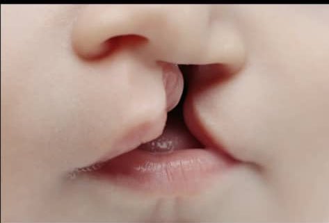 Salam à tous
Je viens vous informer que la réparation des fentes ( palatines et/ou labiales) est gratuite à l'hôpital général Idrissa Pouye (ex CTO).

Je vous prie de bien vouloir partager l'information afin que le maximum de nécessiteux puissent en bénéficier.
#Rtapprecié