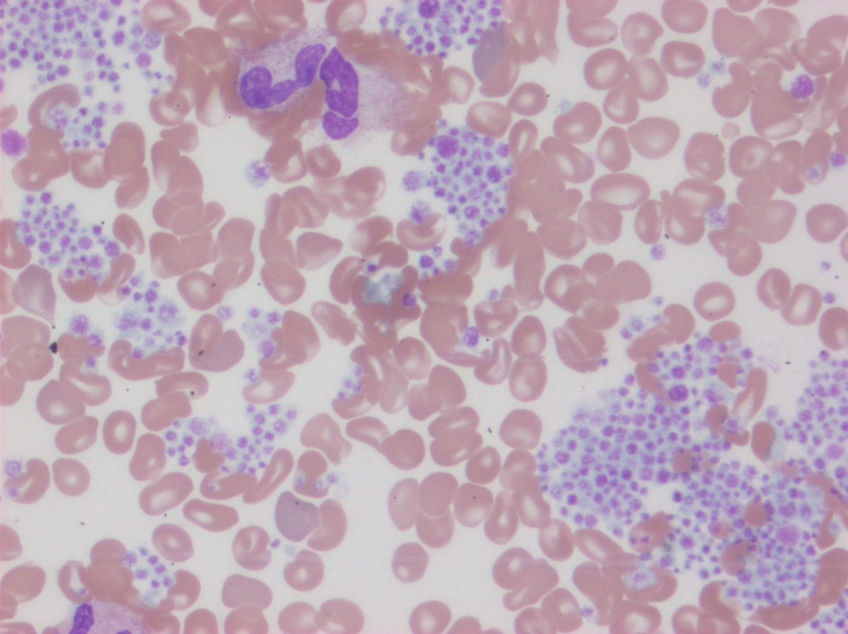 Hey - why is the platelet count "unreportable"? Oh, now I see -&gt; Peripheral blood smear near edge