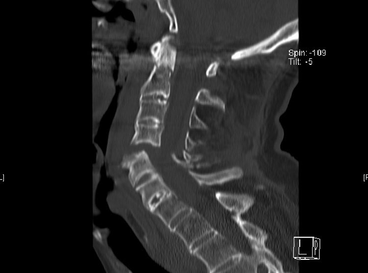 I guess in every bigger trauma center cases like this are seen - maybe every 2 years, maybe more often. Ankylosing disorders and trauma = tremendously increased risk of fractures and severe neurological deficits, but... in first line it’s about surviving the compromised airway 