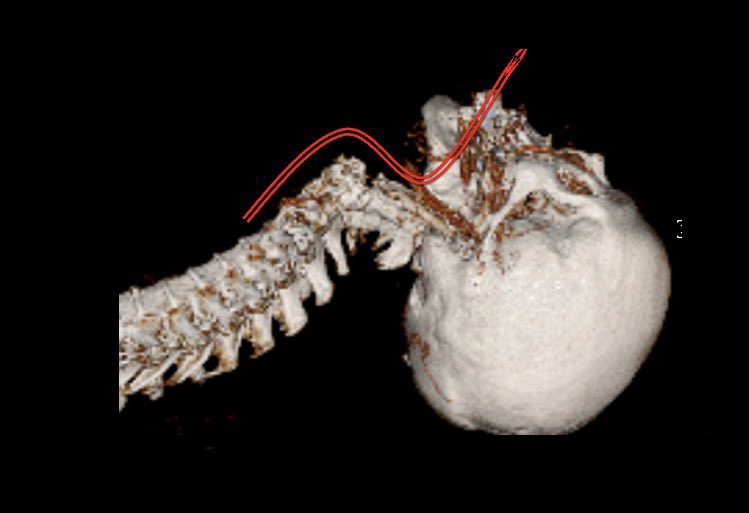 The ER-doc or anaesthetist and the spine surgeon/trauma surgeon have to act quickly now. This patient detoriated quickly after the CT scan and intubation was impossible. So quicktrach (cannula over needle) was performed. That saved this life!