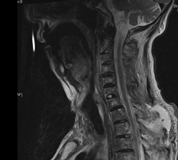 Why all posterior? Because anterior is not necessary! The cervical spine has the biomechanics of a long bone: Double plating not necessary in femoral shaft fractures (a LISS plate is enough). Only in pseudarthrosis/revision I take it into consideration to add anterior fusion.