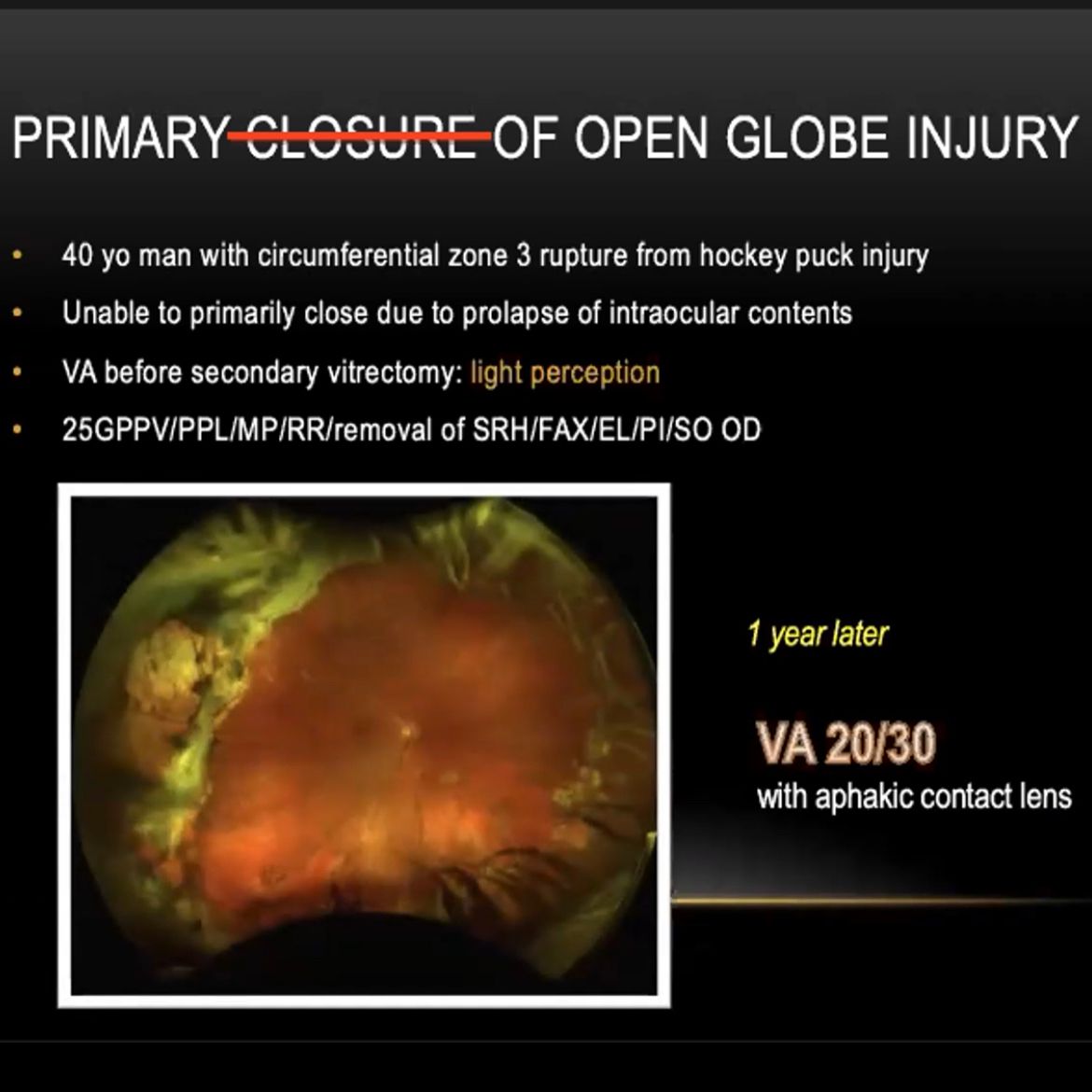 Nouraalmanso0ri's tweet photo. An exceptional case of open globe that was not possible to do complete primary closer that ended up with a good outcome at one year follow up #Ophthalmology #savingvision #ophthalmologists https://t.co/GzB806y6xA