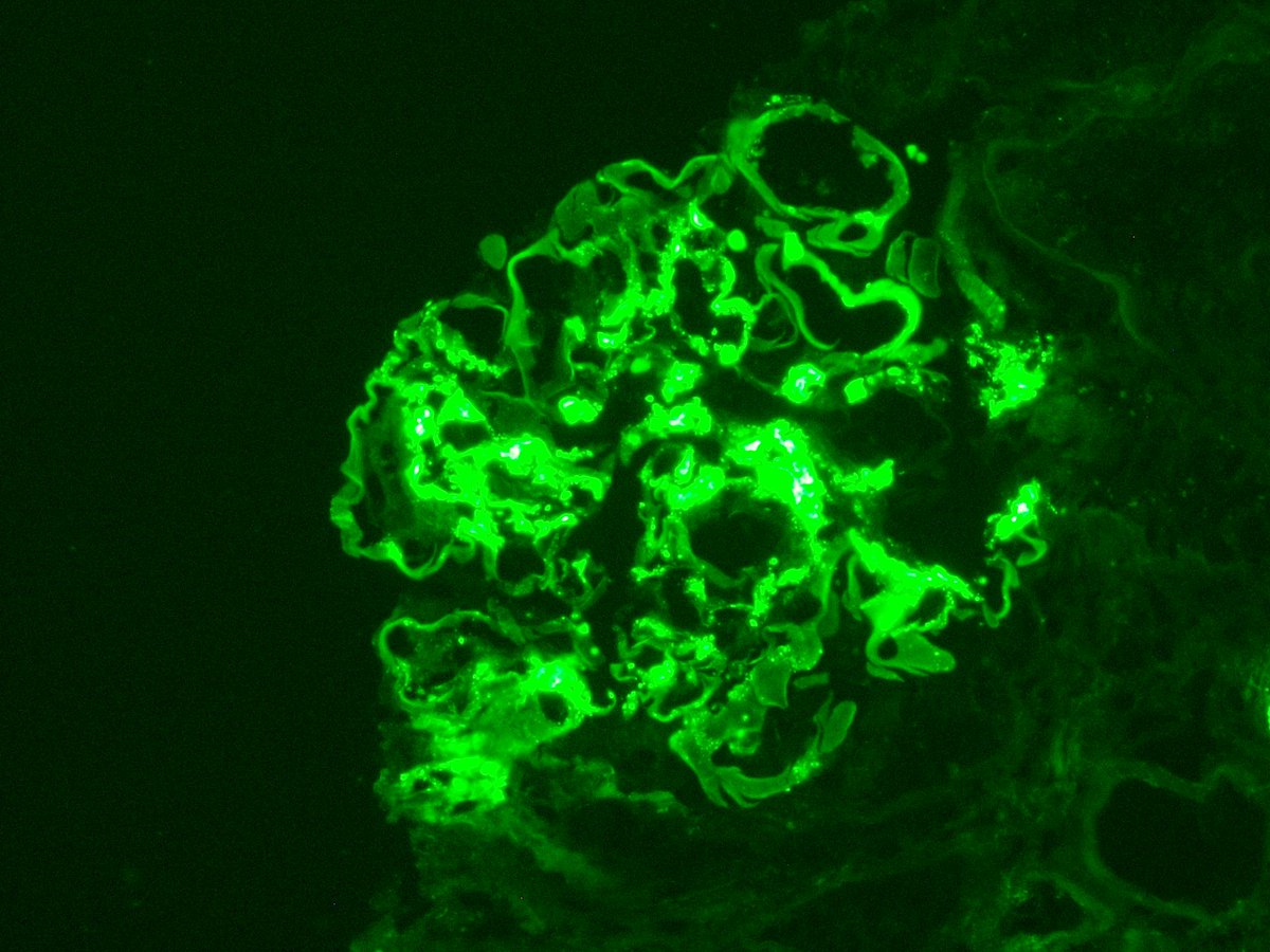 Male adult, proteinuria, RBC casts, high serum creatinine. High power view of a glomerulus (silver stain). Name the lesion (top left). IgA immunofluorescence reaction shown (also C3, lambda, weaker kappa). Dx? #renalpath #pathtwitter #pathspotter #pathresidents