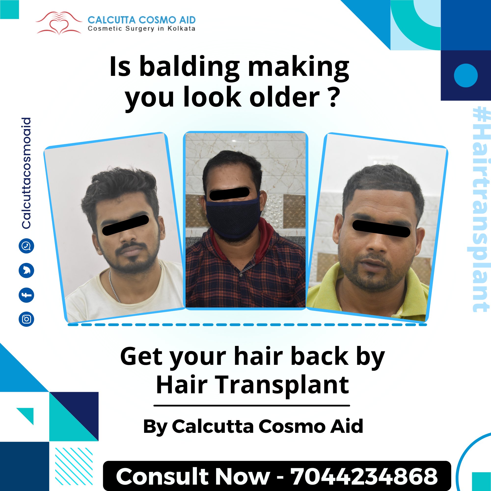 Dr Anand K Nagwani - Hair Transplant on Twitter: Dr Anand K Nagwani - Hair Transplant on Twitter: