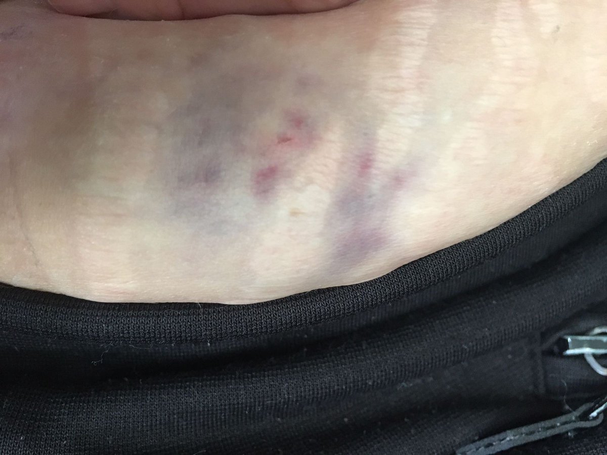 TotsShelly's tweet photo. Injection went a bit wrong yesterday. If I had a R100 for every injection I've had I would be a billionaire. Thanks Cancer you asshole. Cancer peeps - we endure a lot to stay alive dont we. Its painful and exhausting! #mbc4 #CancerGoToHell #breastcancer #weneedacure https://t.co/mrOqN8yaqD
