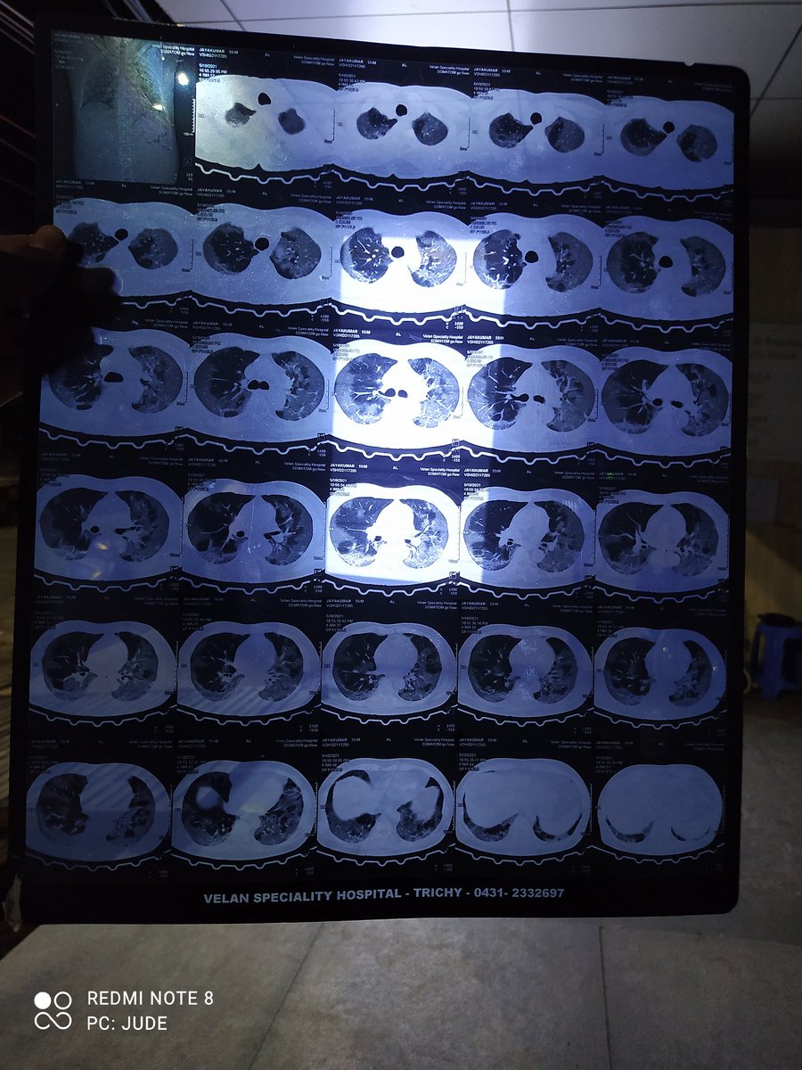 BenhurSpeed's tweet image. Sir
My father Mr.Jayakumar admitted in SUNDARAM HOSPITAL, puthur, Trichy, Tamilnadu for COVID treatment....he is in very critical condition... So far we have spent 5 lakhs. We require another 5 lakhs minimum for his further treatment. Kindly help us...
Jude
9600677935