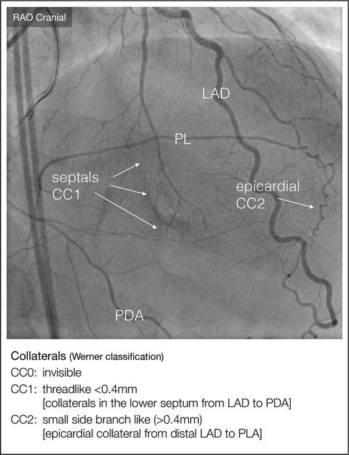 w_jyg's tweet photo. One of the #advice from the expert panelist this morning in #CTO Arena
Always try with soft #polymer wire eg #FielderXT as it may find its way into the #microchannel, which often #NotVisible in CAG.
#Perfect Result at the end
#EuroPCR @PCRonline @CtoEuro @CTOcomplication https://t.co/M1NI4QSuG3