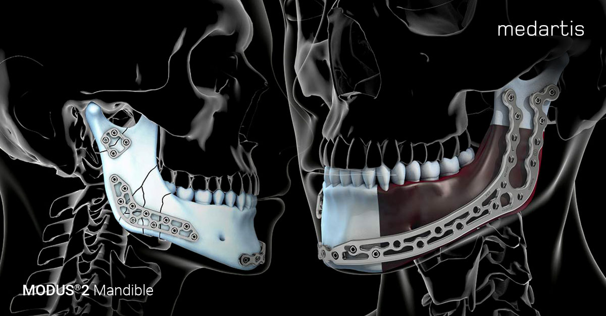 Medartis_Global's tweet image. The new MODUS 2 Mandible offers a wide range of plate designs for a variety
of mandibular treatments. Click bit.ly/3qyb4Vi for more information!

#CMF #MODUS2 #Medartis