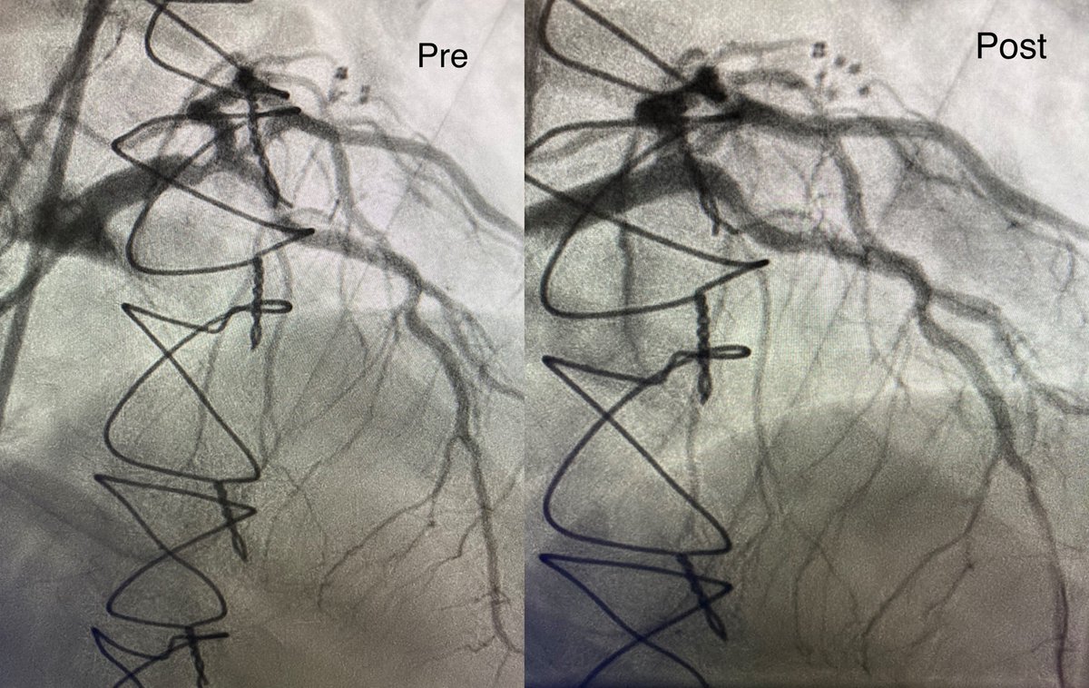 #IVUS of the LM, wire in both LAD &amp; Cx. 3.5 #ShockwaveC2 for 40 pulses to treat distal LM into prox LAD. 3.5x16 Synergy stent followed by 4.0 &amp; 4.5 NC balloon. Great #CoronaryIVL result by Dr <a href="/bdcogar/">Bryan Cogar</a> at <a href="/integrishealth/">INTEGRIS Health</a> in Oklahoma City!
ISI bit.ly/3rnUXue #CardioTwitter