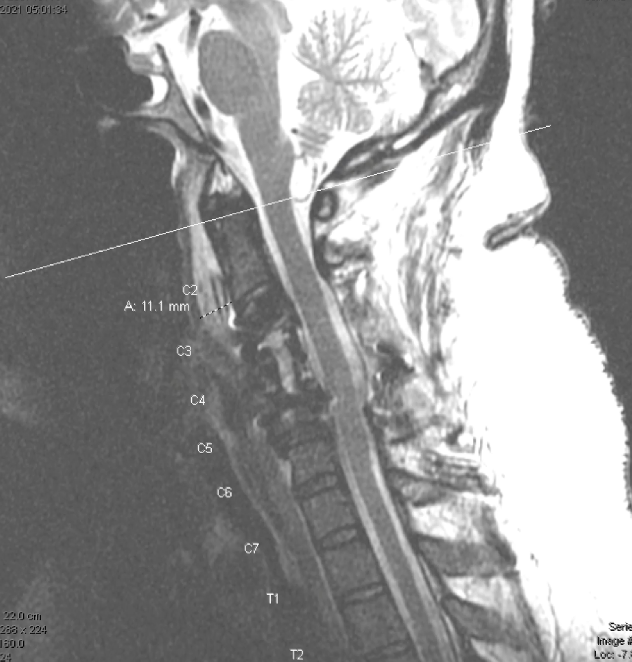 JackJalloMD's tweet photo. Cervical #tumor case in 34 yr/old female.  No #neurological complaints or pertinent medical history.  C2-C6 posterior decompression &amp; fusion w/r sided complete #facetectomies at C3-C5 &amp; tumor resection. @TJUHNeurosurg #MedTwitter @JeffersonUniv #spinesurgery #Neurosurgery https://t.co/Ja1nXBawf5