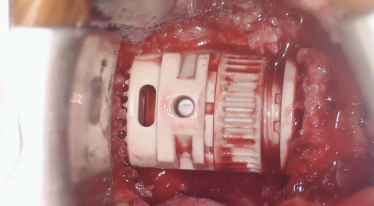 JackJalloMD's tweet photo. Cervical #tumor case in 34 yr/old female.  No #neurological complaints or pertinent medical history.  C2-C6 posterior decompression &amp; fusion w/r sided complete #facetectomies at C3-C5 &amp; tumor resection. @TJUHNeurosurg #MedTwitter @JeffersonUniv #spinesurgery #Neurosurgery https://t.co/Ja1nXBawf5