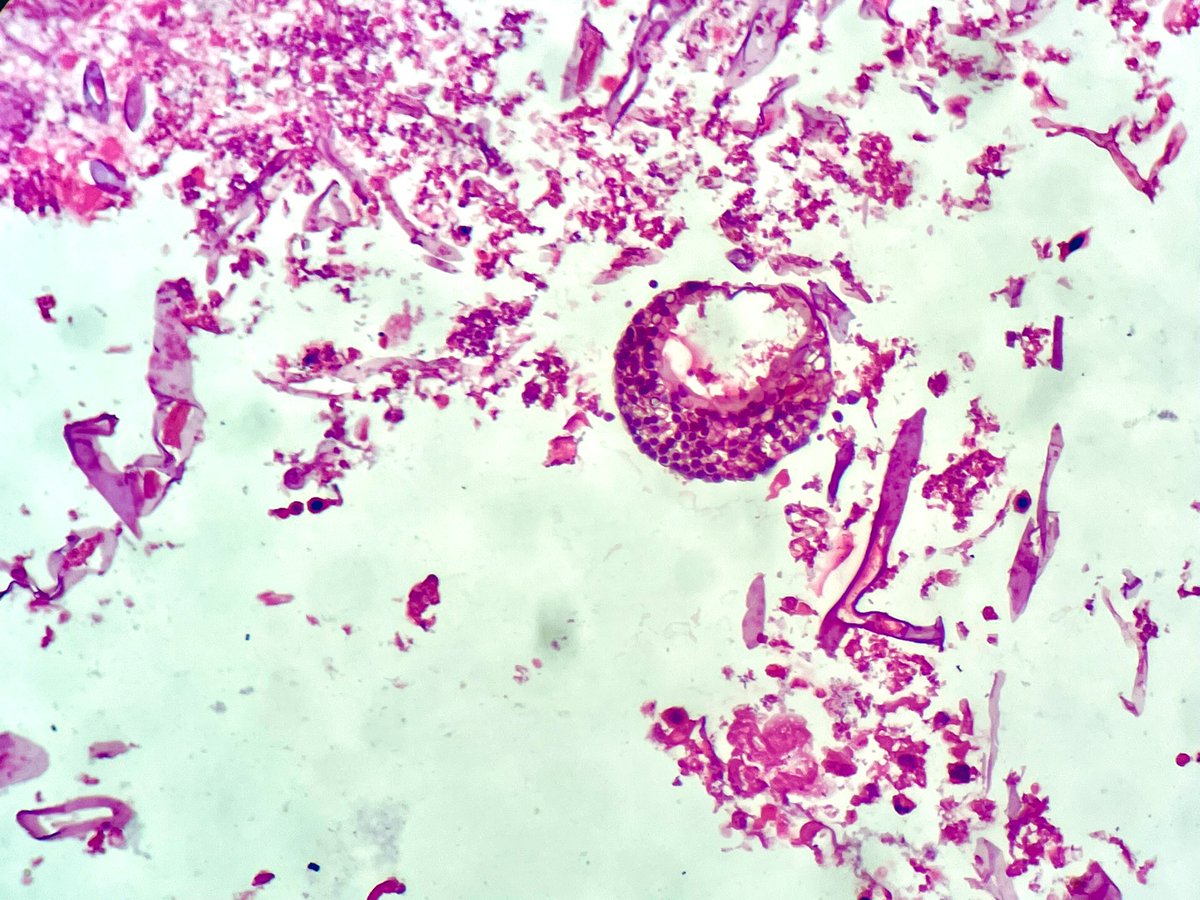 NidhinMd's tweet image. The black fungus again! Can you see those sporangium? A Case of severe Covid Pneumonia with nasal mass. #Covid_19 #twitterpath #PathTwitter #pathresident #pathology #Mucormycosis #MedTwitter #diagnosis