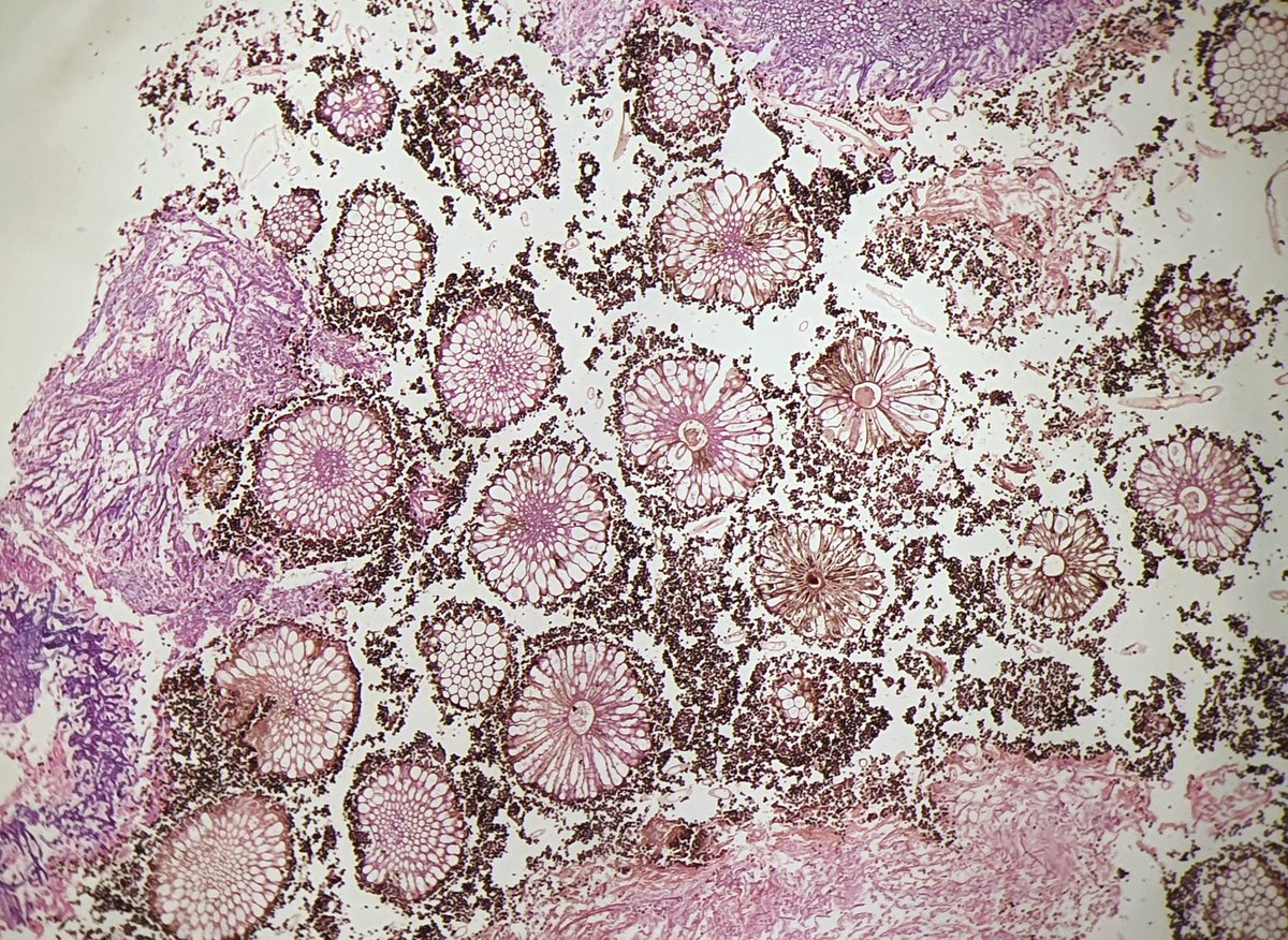 Beautiful but deadly!  in a young covid patient nasal biopsy😵😕
#pathboards #pathology #pathtwitter #pathbugs 
@DrGeeONE @vi_monappa @padmapathology1 @Divya_Madhala @SumantaDas_7 @pepeheffernan @atman_ci @TristanRutland7 @Venkateshgilly2 @kriyer68 @RunjanChetty