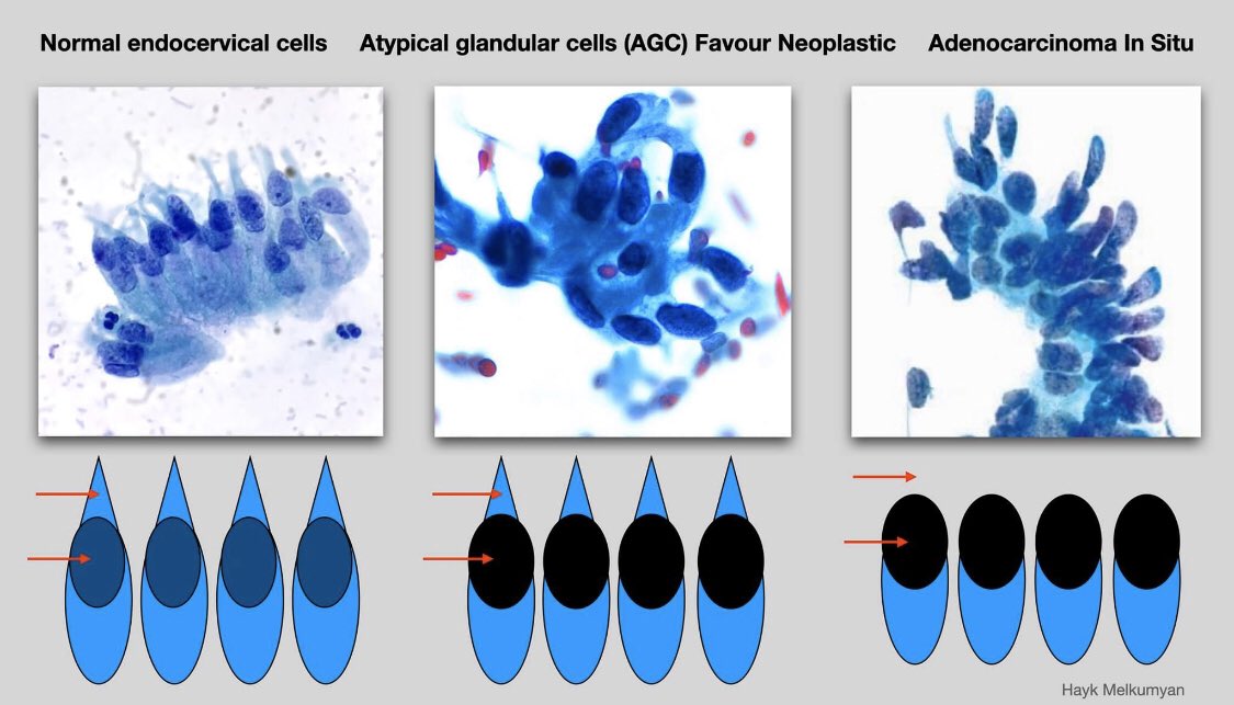 VirajSadrani's tweet image. Normal vs atypical vs in situ adenoca on Pap smear #Gpap #pathology #gynecologist #gynypath #histopathology #cancer #surgicalpathology