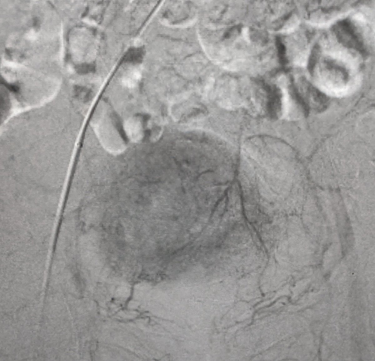 LessneVIR's tweet photo. #adenomyosis does not equal #hysterectomy 

Pt w heavy bleeding &amp; cramping. After #UAE, sx resolved, pt happy, uterus in place! #IRad @CLTRadiology

#KeepYourU @thefibroidlady @keithppereira @DrLipman1 @acog @SIRspecialists https://t.co/aC6dn7VajJ