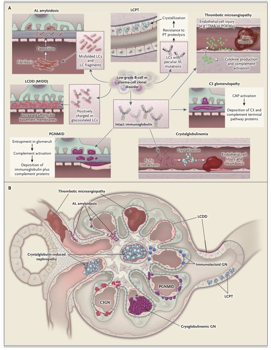 La gammapatia monoclonal de significado renal describe cualquier anomalía clonal de células plasmáticas o células B, que aún no cumplen criterio para cáncer, pero producen inmunoglobulinas monoclonales nefrotóxicas.

#ISNyoung

NEJM 2021
DOI: 10.1056/NEJMra1810907