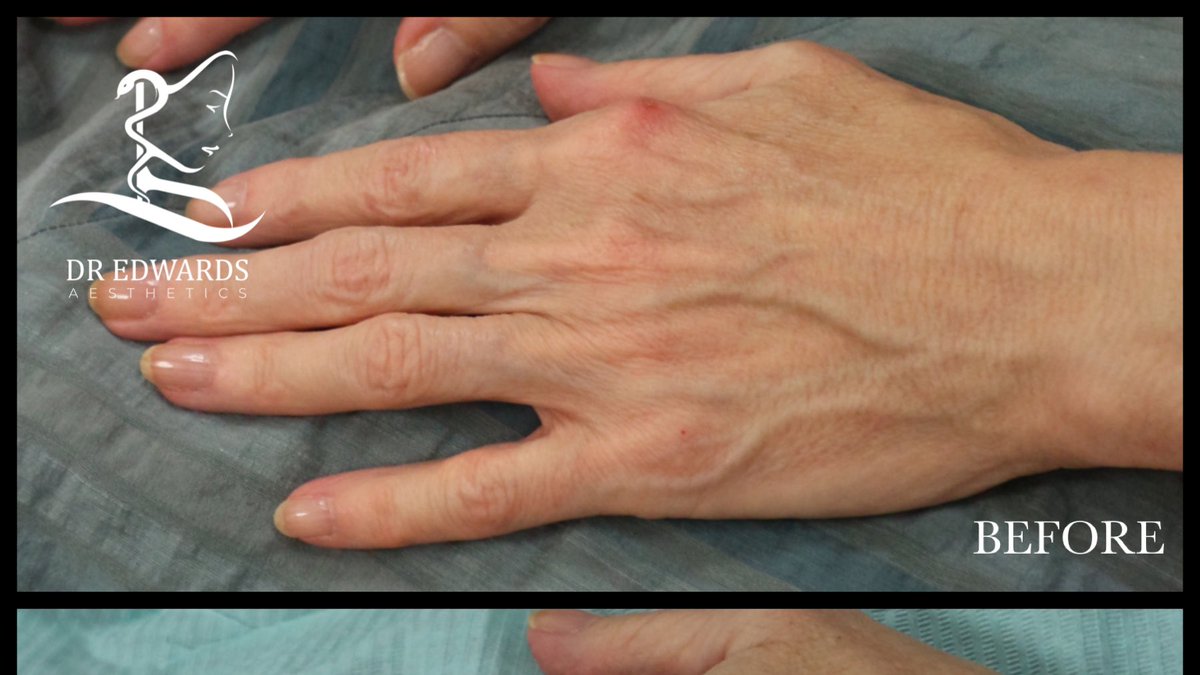 Besides the face and the neck, the back of our hands clearly show the signs of ageing. <a href="/DrREdwards/">Richard Edwards</a> can help replace this lost volume, resulting in a plumper, smoother, more youthful looking hands.