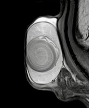 JHernandez_RX's tweet photo. Radiopathological correlation of a testicular epidermoid cyst: on your left is the sagital T2WI and on your right the gross pathology specimen. Notice the onion skin pattern in the MRI image @EAHornia @cookyscan1 @ErickMRemer @NickSchiedaMD @AmitUrorad @LaraHarikMD @RadiologiaBcn https://t.co/SMjGyv6F3J