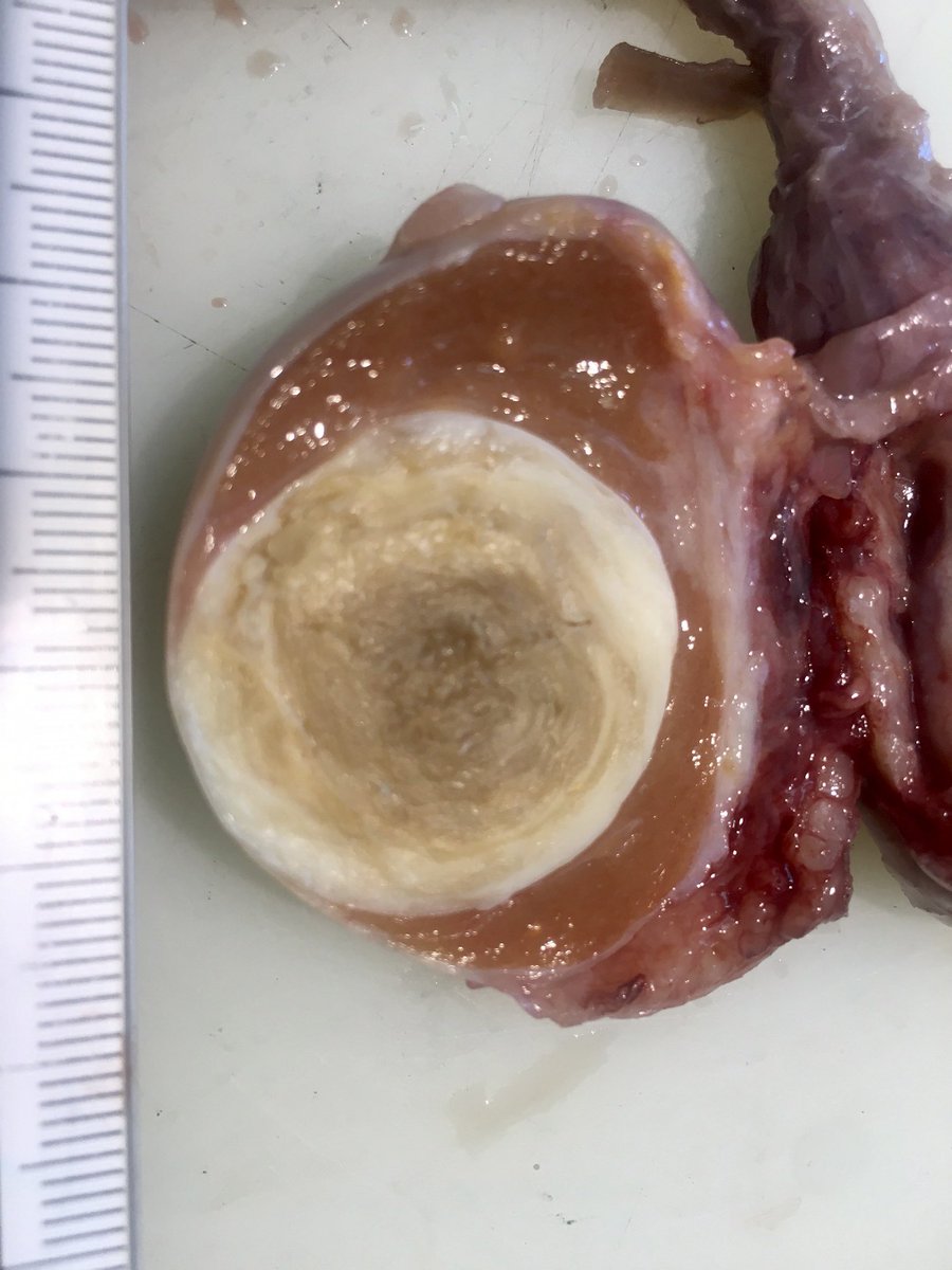 JHernandez_RX's tweet photo. Radiopathological correlation of a testicular epidermoid cyst: on your left is the sagital T2WI and on your right the gross pathology specimen. Notice the onion skin pattern in the MRI image @EAHornia @cookyscan1 @ErickMRemer @NickSchiedaMD @AmitUrorad @LaraHarikMD @RadiologiaBcn https://t.co/SMjGyv6F3J