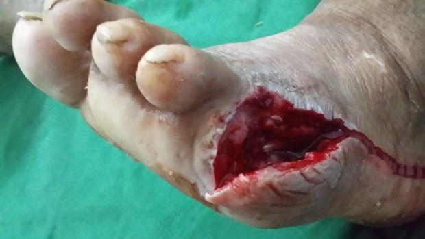 examroomtales's tweet photo. Can't believe how lucky this diabetic patient was to survive. Story: https://t.co/98QF9MHWZb

#diabetes #homehealth #home #story #medicine #health #nurse #nursing #nursingstudent https://t.co/y5NkyrG2pY