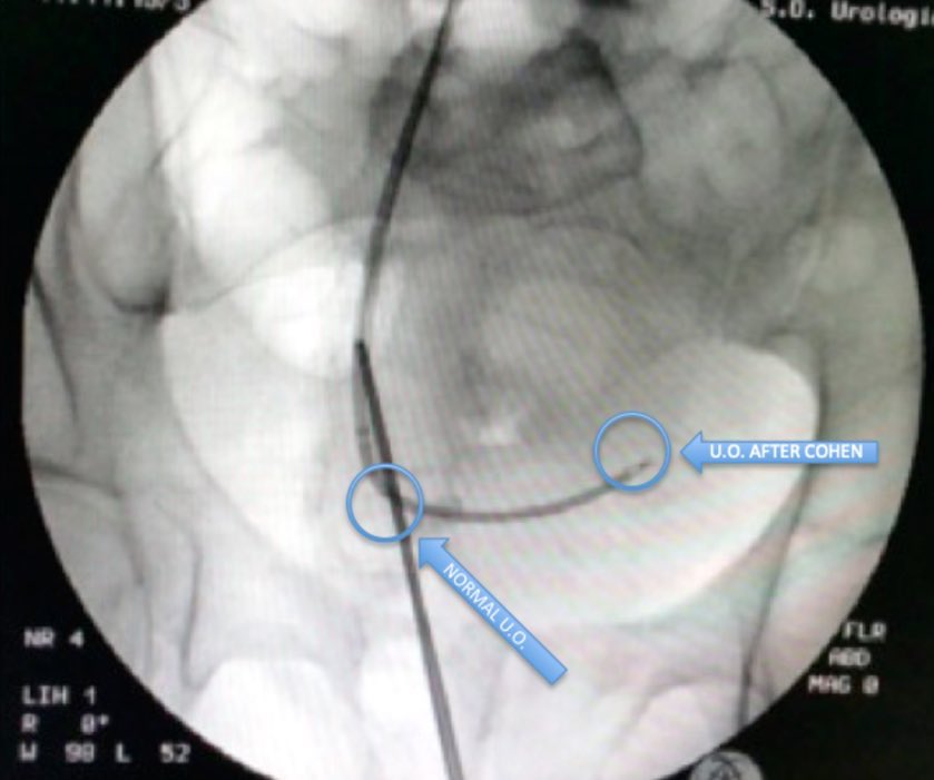 GuidoGiusti's tweet photo. When u deal with ureteric stone in pt with previous pediatric reimplantation consider that it could b a #COHEN 1 where retrograde manipulation is mostly impossible:b ready 2 go antegrade #FURS placing a #UAS as an #amplatz sheath! #supine position eases the choice!#ETCE #teamwork https://t.co/rDh9Jn9NGN