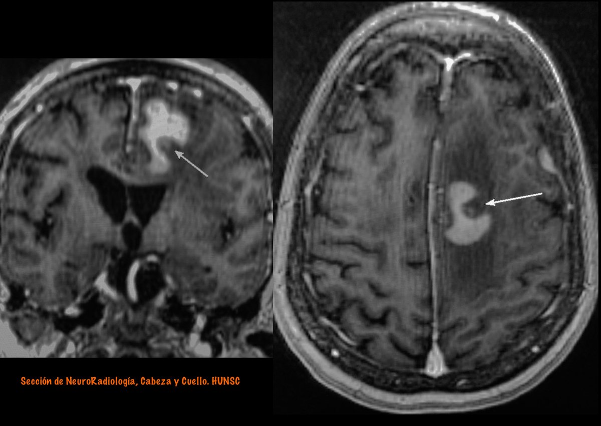 #FOAMrad #radres #neurorad #HUNSC #radiologysigns 

Primary Central Nervous System Lymphoma (PCNSL)
At left  axial FLAIR and coronal T2 (top)
DWI and ADC (down)
At right enhanced T1 MRI with “Notch Sign” (arrows)