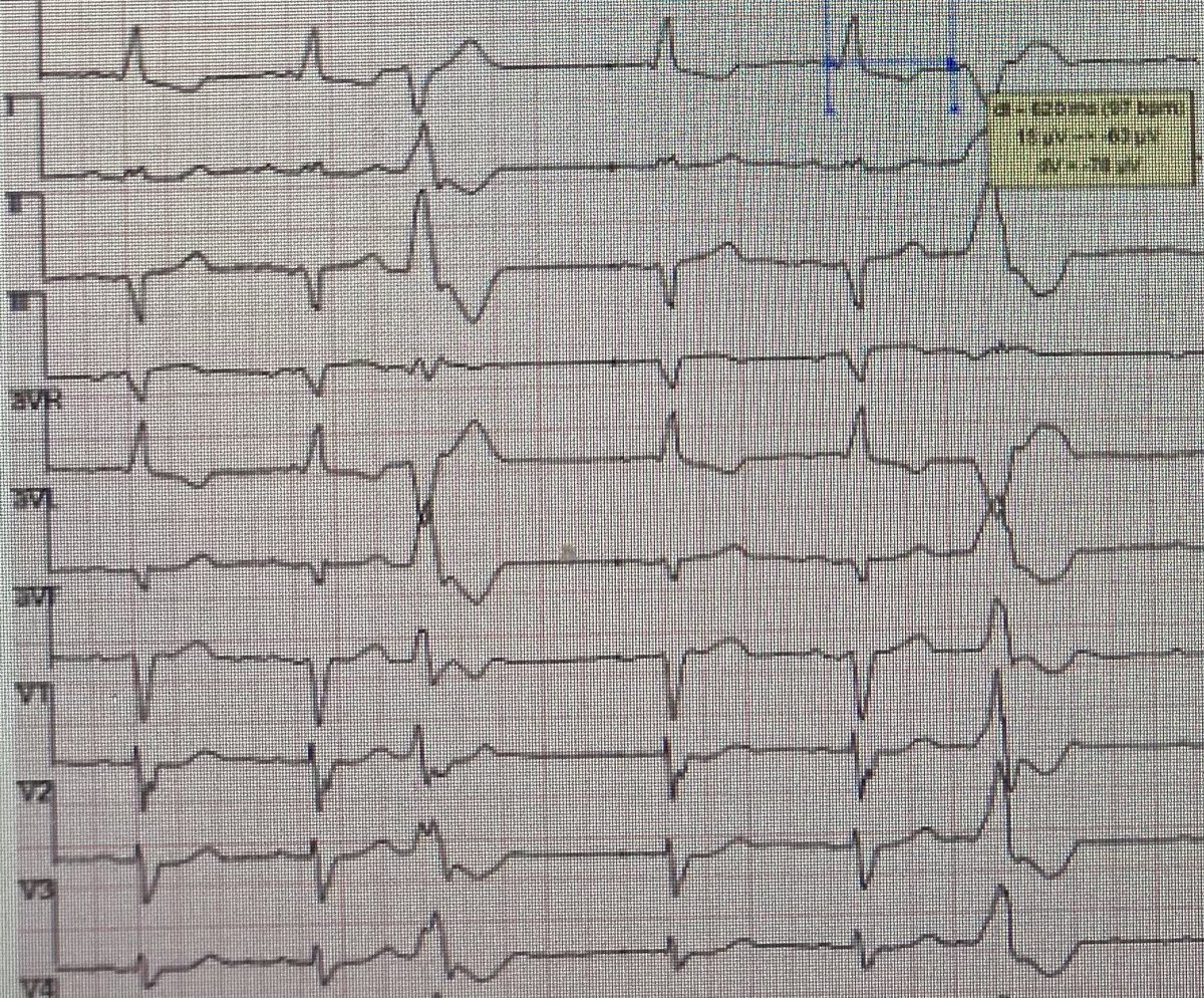 GStokken's tweet photo. @DrAJRestrepo @CarinaHardy4 @drluissaenz @DrFerminGarcia @Dr_Santangeli @ftrae @True_EP @Hapa_EP @ALFIEEP1 @annavarr @narrowQRS @VictorBazanG @Zo_EP2 @BradfieldMD @aportasanchez @DrRoderickTung @andresenriqueza Curious what you find. I have a similar one coming up. https://t.co/Ci4cOjDCjY