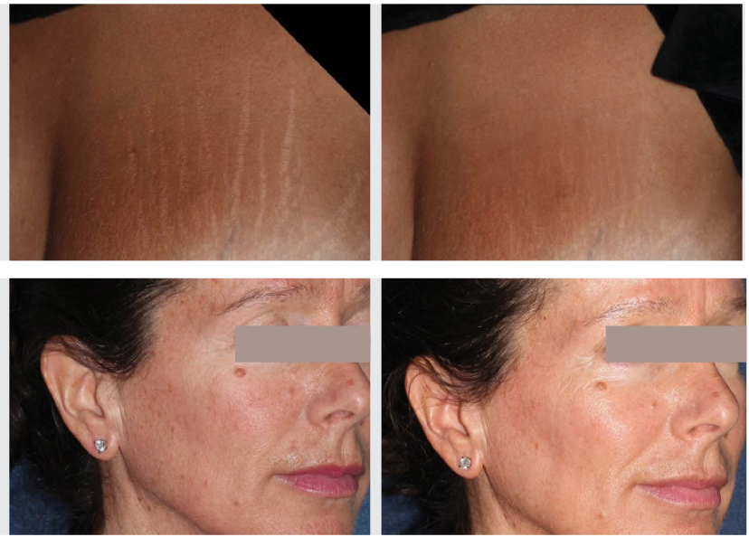 Book an #IPL and #ResurFX treatment with Skintuition for the full Photofractional facial! 
Visit us at ow.ly/arIx50EN53Y and book an appointment! 
#skintuitionltd #aesthetics #summerglow